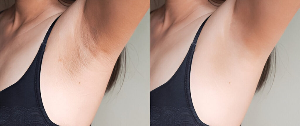 how to remove underarm darkness in tamil 2 how to remove underarm darkness in tamil