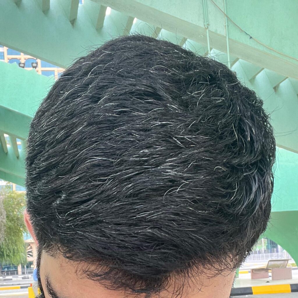 remove grey hair on young age